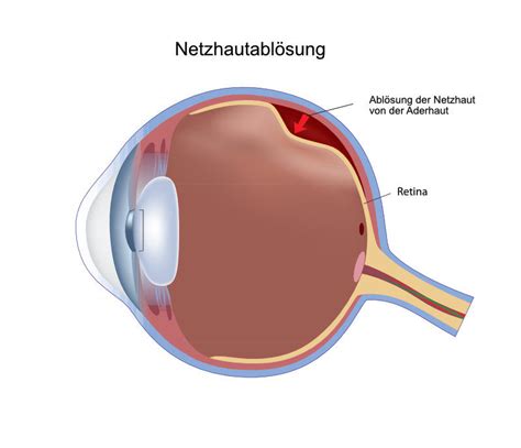 Netzhautablösung eine Erkrankung des menschlichen Auges