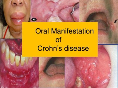 Dental Consideration For Inflammatory Bowel Disease