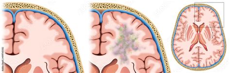 Fototapeta Ilustración descriptiva de una leucoencefalopatía multifocal