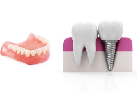 Dental Implants Vs Dentures What Is Right For You First Class Smiles