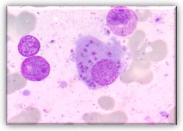 bone marrow aspirate macrophages  leishman donovan bodies