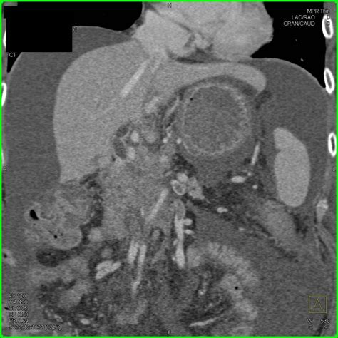 Pancreatic Cancer Encases The Portal Vein And Superior Mesenteric Vein