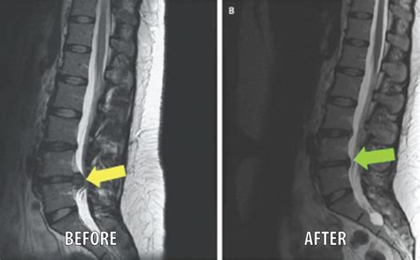 Spinal Decompression in Encino, CA | Atlas Health Care Center