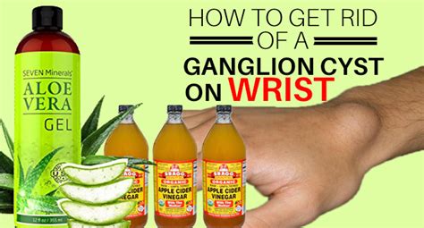 How to Get Rid of a Ganglion Cyst on Wrist - Remedies Lore