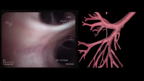 segmental anatomy during bronchoscopy - YouTube