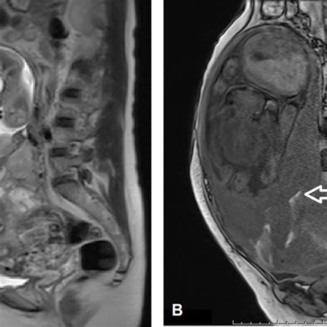 A 26 Year Old Woman Performed In 2 Times Of Mri A At Ga 23 Weeks