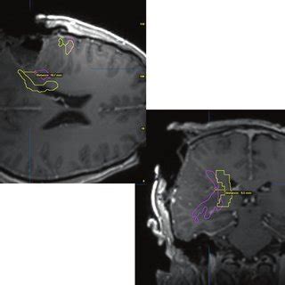 Intraoperative integration between DTI and volumetric magnetic ...