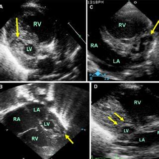 Two Dimensional Echocardiograms From Four Patients A Parasternal