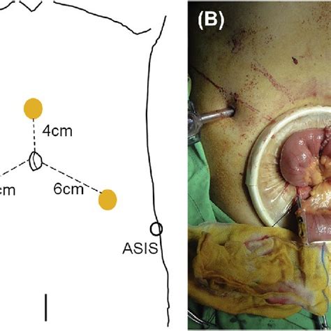 Four Port Placement For Laparoscopic Radical Cystectomy With