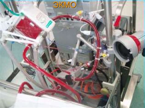 Экстракорпоральная мембранная оксигенация (ЭКМО, ЭМО, ECMO, ЭТМО ...