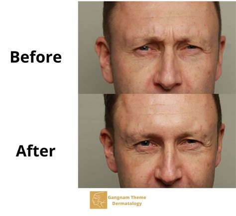 Before And After Theme Dermatology