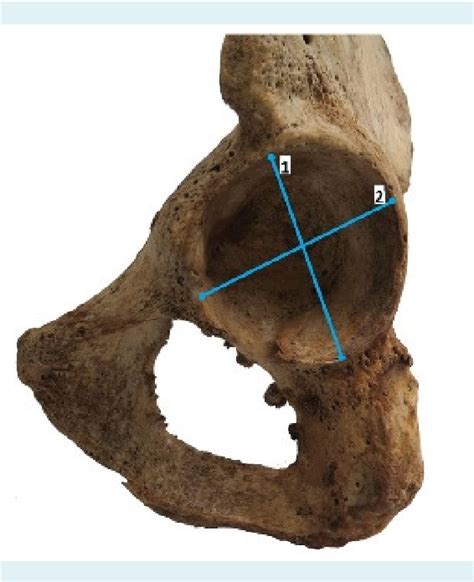 PDF Acetabular Osteometric Standards For Sex Estimation In