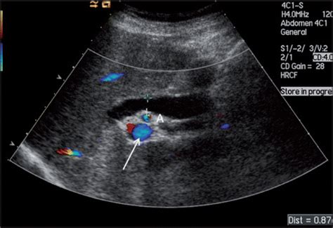 Abdominal Ultrasound Made Easy Step By Step Guide Pocus 53 Off