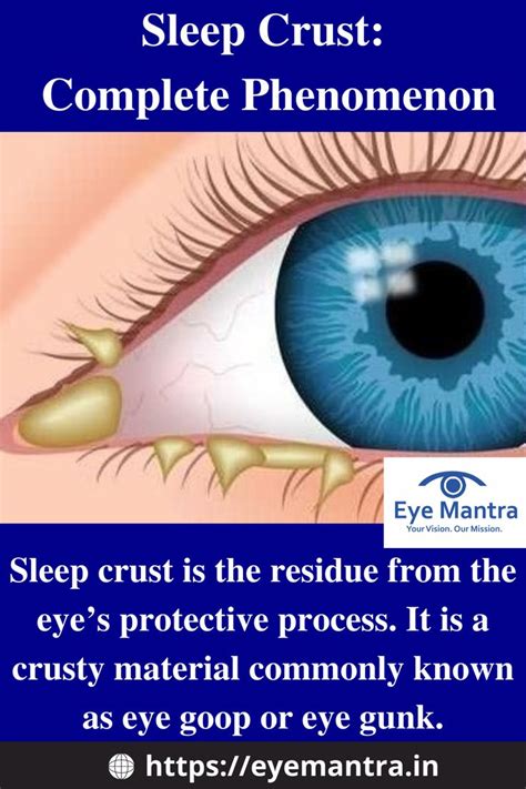 Sleep Crust The Complete Phenomenon Sleep Crusts In Babies Eyes