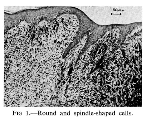 Figure 1 From Fine Structure Of An Intraoral Nevocytic Melanoma