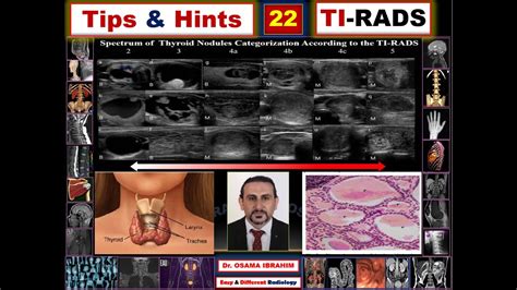 Tips Hints Ti Rads How To Score Thyroid Nodule Youtube