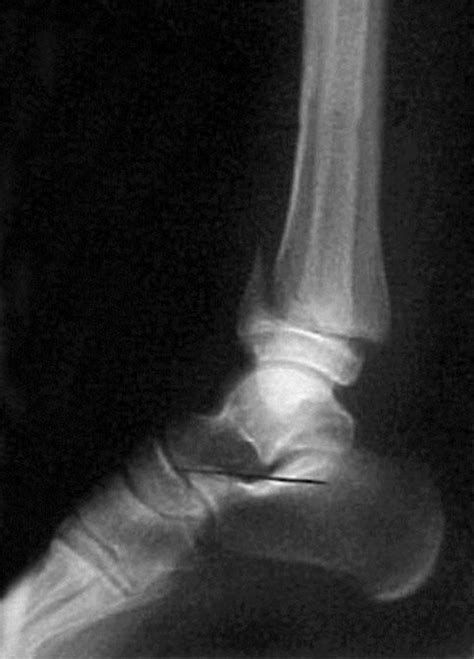 Salter Harris Fracture Imaging Overview Radiography Computed Tomography Radiography