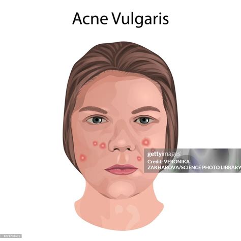 Acne Vulgaris Illustration High Res Vector Graphic Getty Images