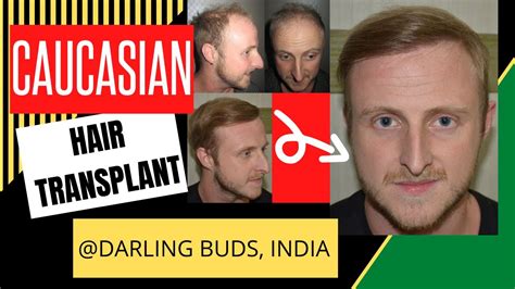 Caucasian Hair Transplant In India Grade 5 Darling Buds Clinic Youtube