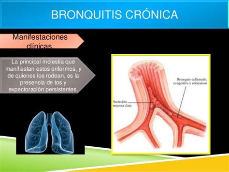 Epoc Enfisema Bronquitis Crónicabronquiectasia Y Asma