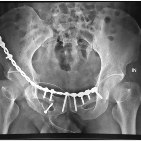 X ray evaluation post ORIF of anterior pelvic ring. | Download Scientific Diagram