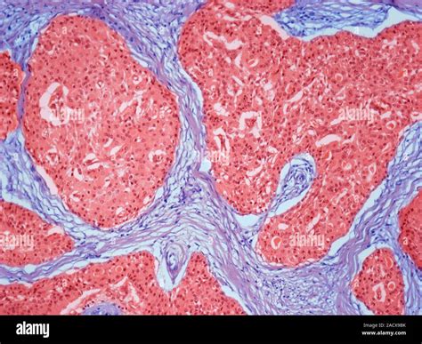 Salivary Gland Oncocytoma Light Micrograph Section Through An Area Of