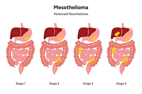 Premium Vector | Mesothelioma disease Pericardial mesothelioma