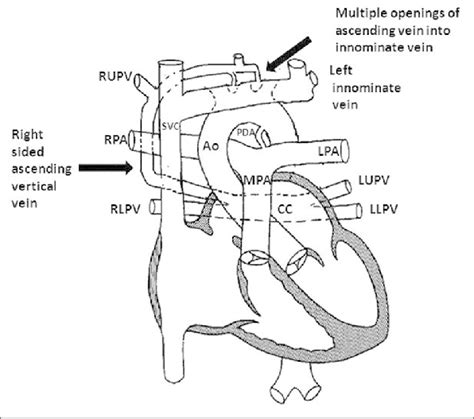 Line Diagram Showing The Anatomy Noted At Surgery Three Pulmonary