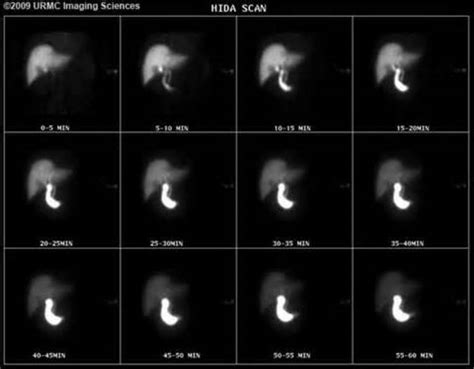 What Happens During A Hida Scan