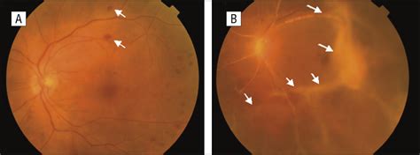 Acute Retinal Necrosis Following Herpes Simplex Encephalitis