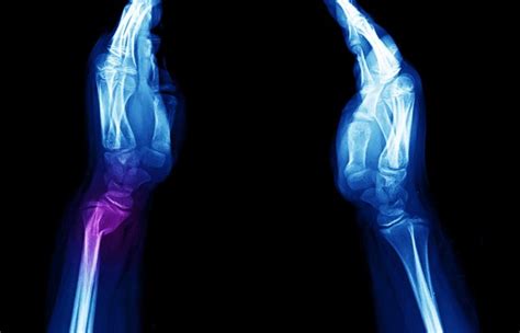4 Dorsal Angulation Royalty-Free Images, Stock Photos & Pictures