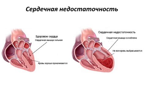 Отеки ног при сердечной недостаточности