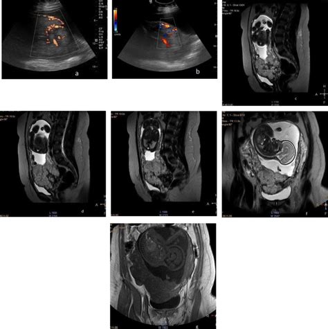 Placenta Percreta Inconclusive Us Findings Color Doppler Us A B Download Scientific