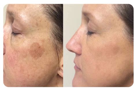 Laser Resurfacing Treatment Logan Ut