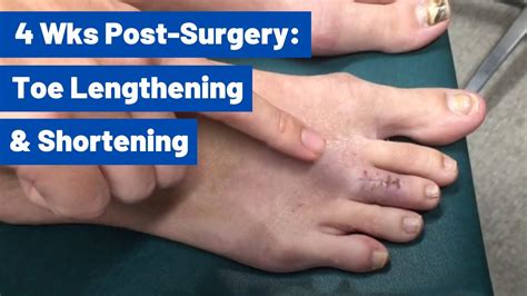 Surgery To Have Pretty Feet