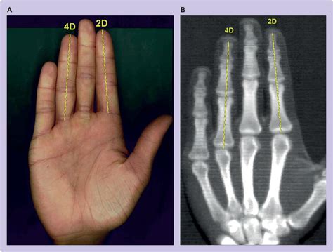 Giving Science The Finger—is The Second To Fourth Digit Ratio 2d4d A Biomarker Of Good Luck