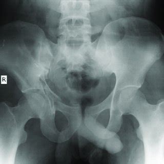 Pelvic Fracture X Ray