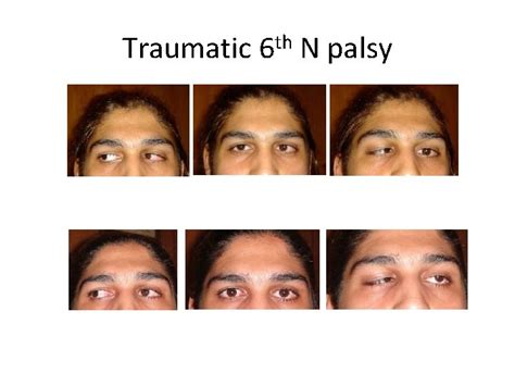 Sixth Nerve Palsy Abducens Nerve Palsy Abbas Attarzadeh