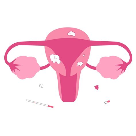 Uterine Fibroid Female Reproduction Organ Problems Infertility Causes