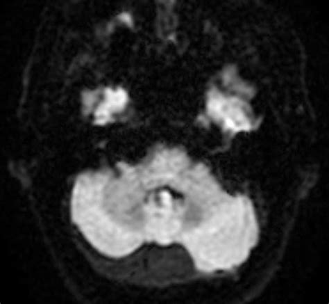 Arachnoid Cyst Neuro Mr Case Studies Ctisus Ct Scanning