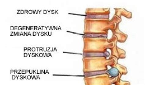 Przepuklina Kr Gos Upa Objawy Leczenie I Przyczyny Portal Doz Pl