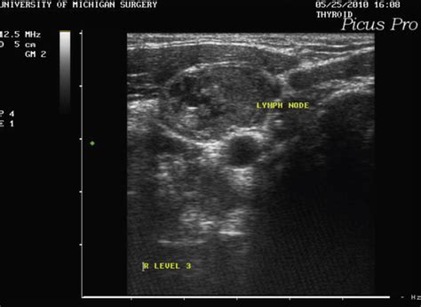 Cystic Neck Lymph Nodes Ultrasound