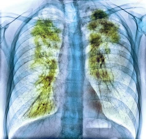 Pulmonary sarcoidosis, x-ray - Stock Image - C037/2868 - Science Photo ...