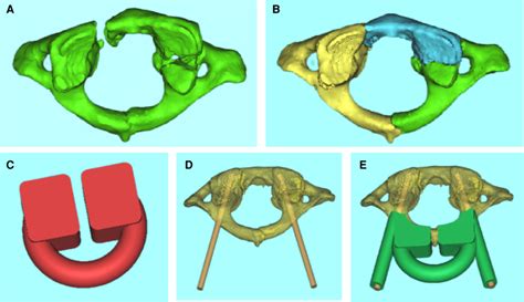 Ae Virtual Reduction Of The Fracture Fragments And Individualized D