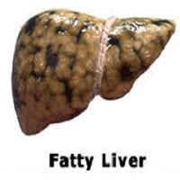 Symptoms of Nash - Fatty Liver Foundation