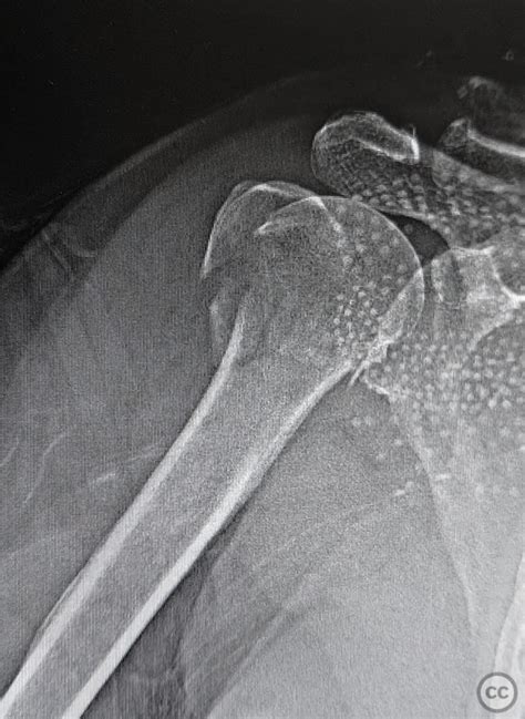 Neer Part Proximal Humerus Fracture