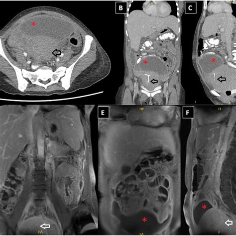 A C Axial Coronal And Sagittal Postcontrast CT Images Showing A