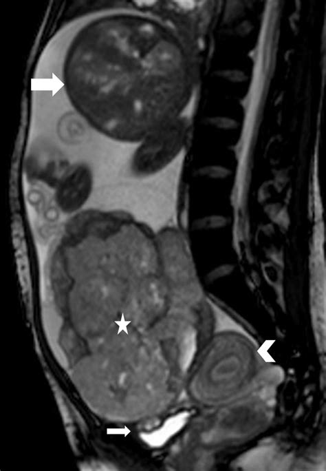 Magnetic Resonance Imaging In Tubal And Non Tubal Ectopic Pregnancy