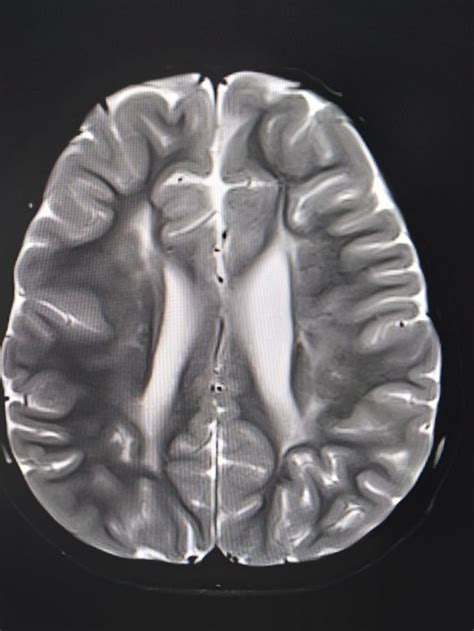 Periventricular Leukomalacia Radiology