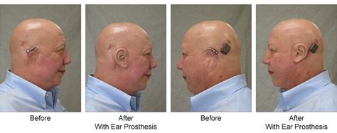 Auricular (Ear) Prosthesis for Osseointegrated Ear Implant | Custom ...